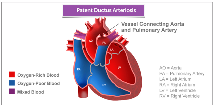 Acyanotic Congenital Heart Lesions Part 1 From Pedscases With Additional Resources Tom Wade Md